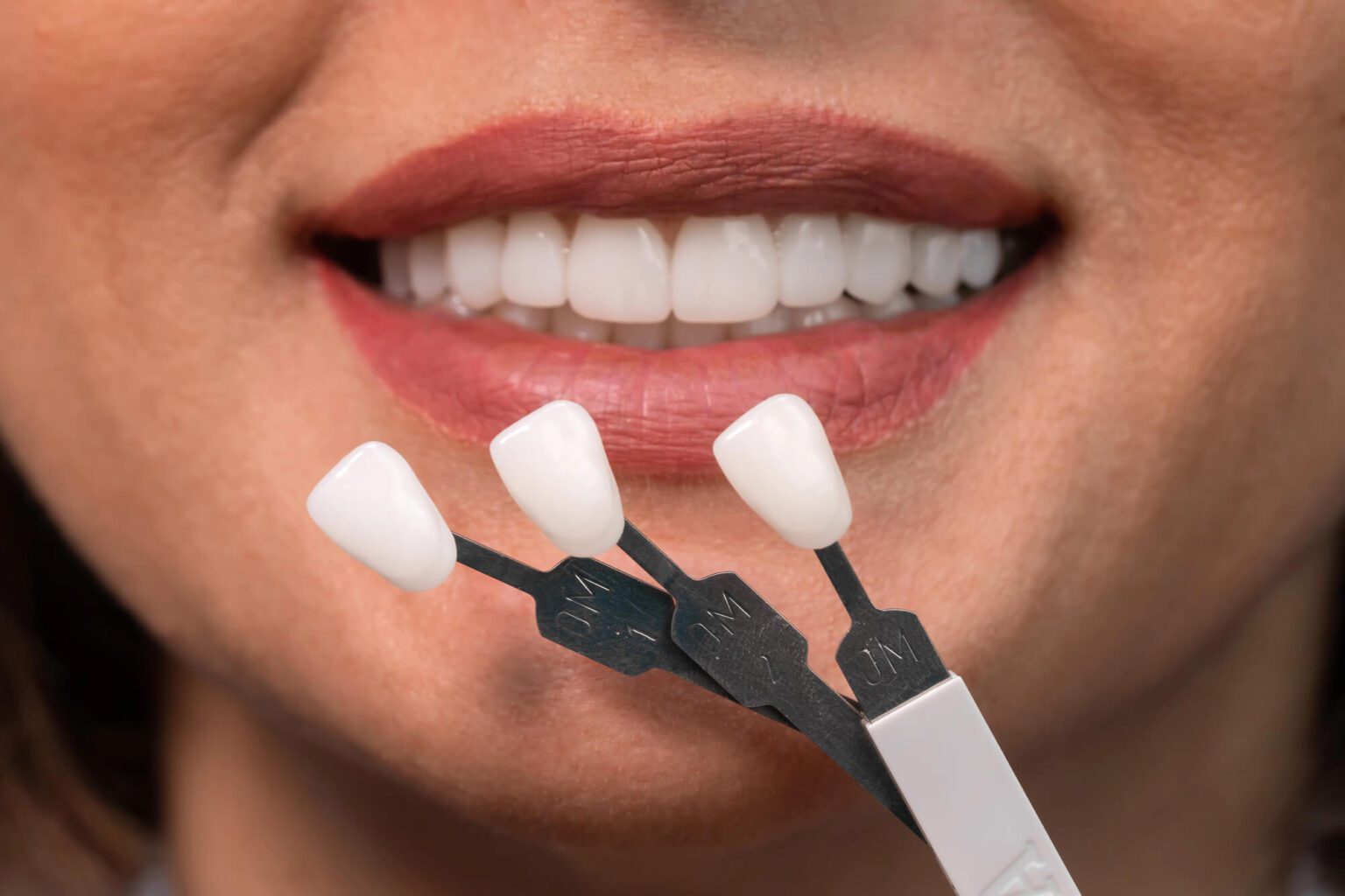Veneers in Hyderabad - Park Dental Care Invisalign