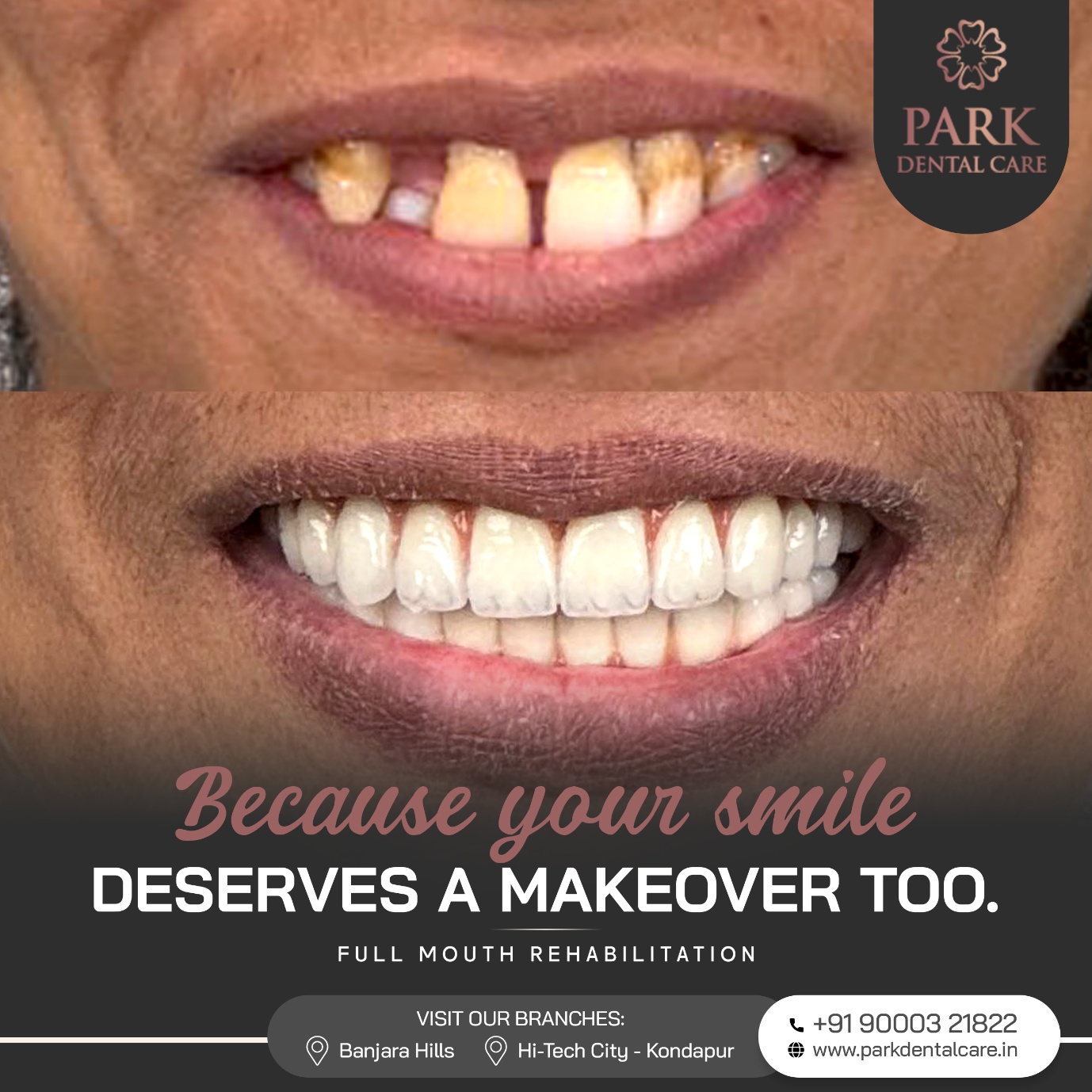 Before and After Smile Transformation