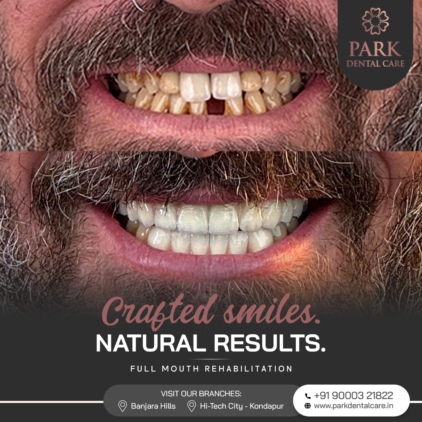 Before and After Smile Transformation