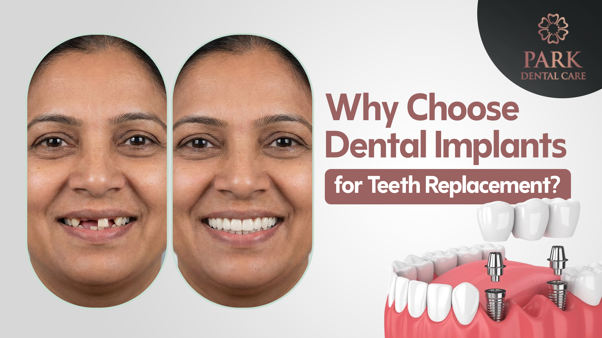 Why Choose Dental Implants for Teeth Replacement