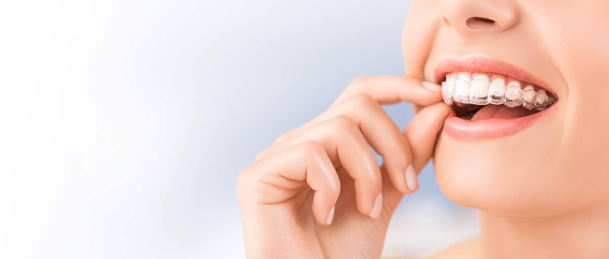 Dental Tourism in Hyderabad - Park Dental Care Invisalign