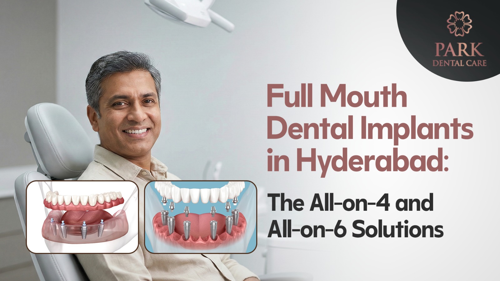 Full Mouth Dental Implants in Hyderabad: The All-on-4 and All-on-6 Solutions