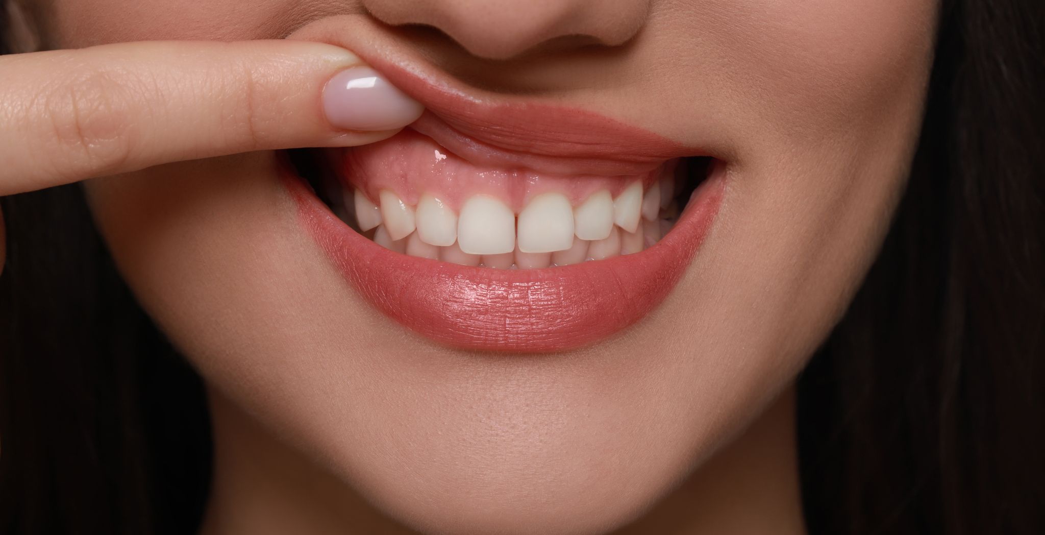 Gummy Smile Correction at Park Dental Care