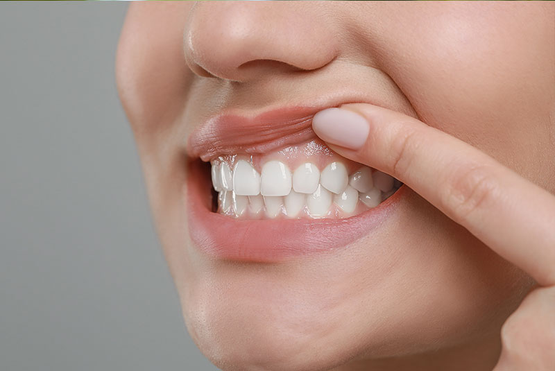 LANAP Laser Gum Treatment