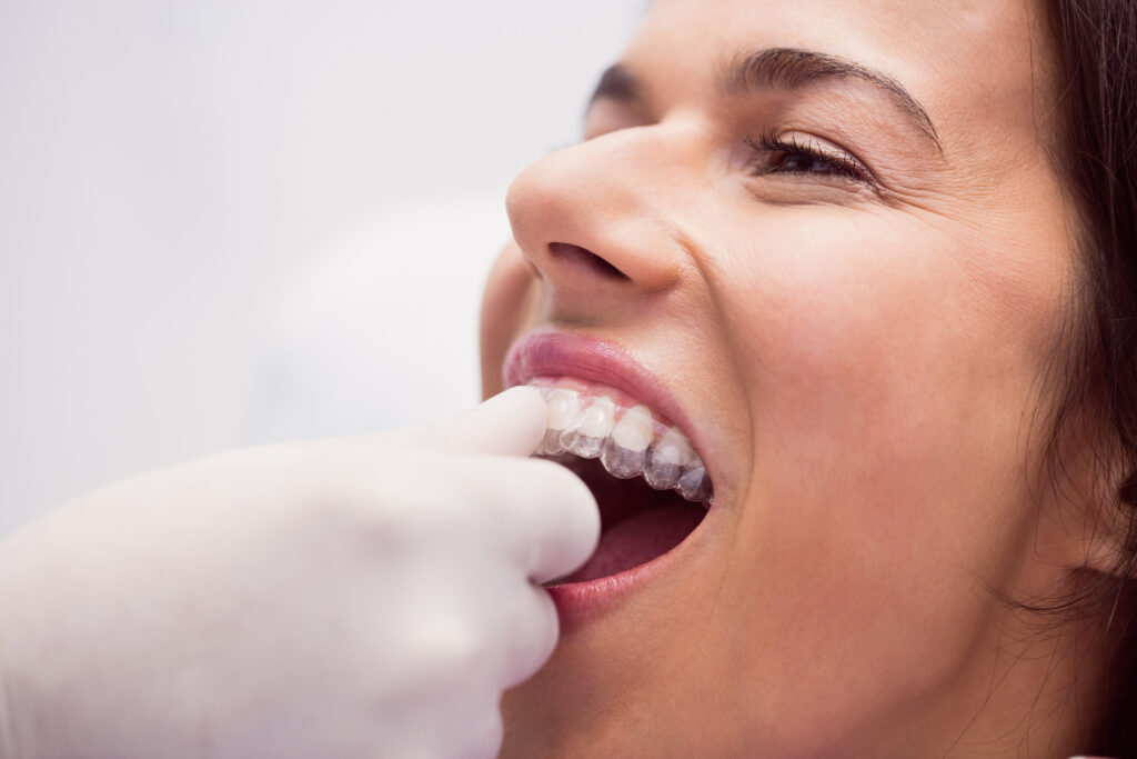 Invisalign with Elastics to Fix Complex Bites - Park Dental Care Hyderabad