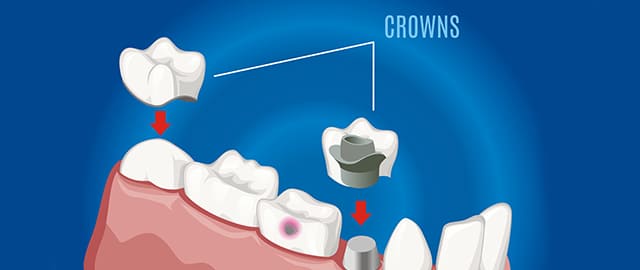 dental-crown