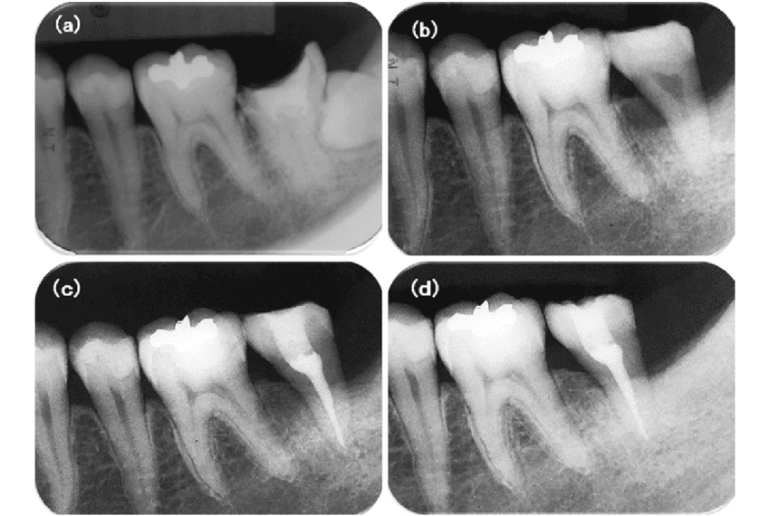 dental-crown