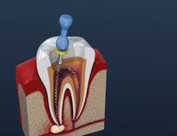 dental-crown