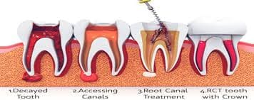 dental-crown