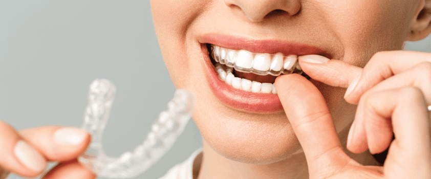 Invisalign - Elegant Dental Care